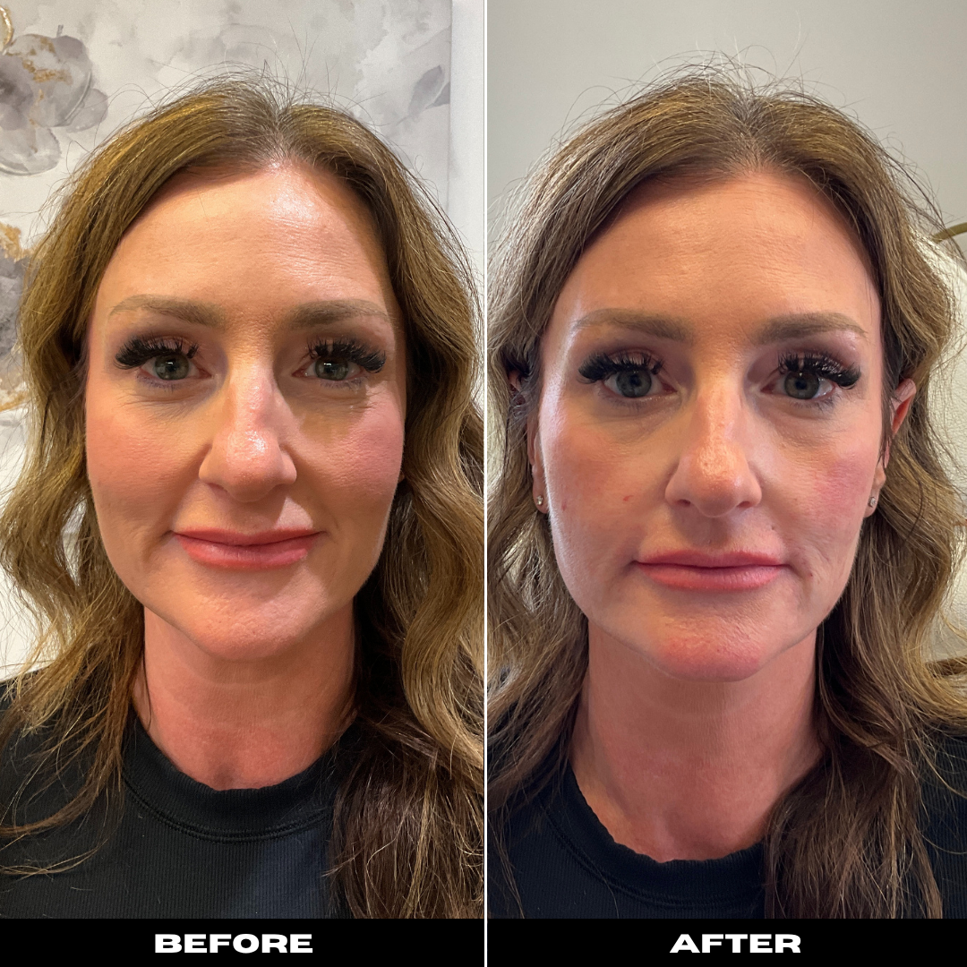 Before and After Image: Belotero - front
