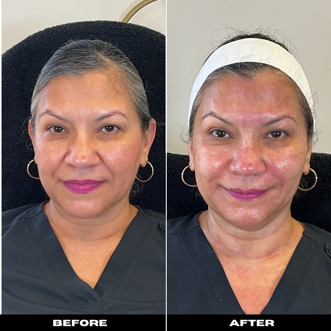 Before and After Image: Microneedling with PRP - front